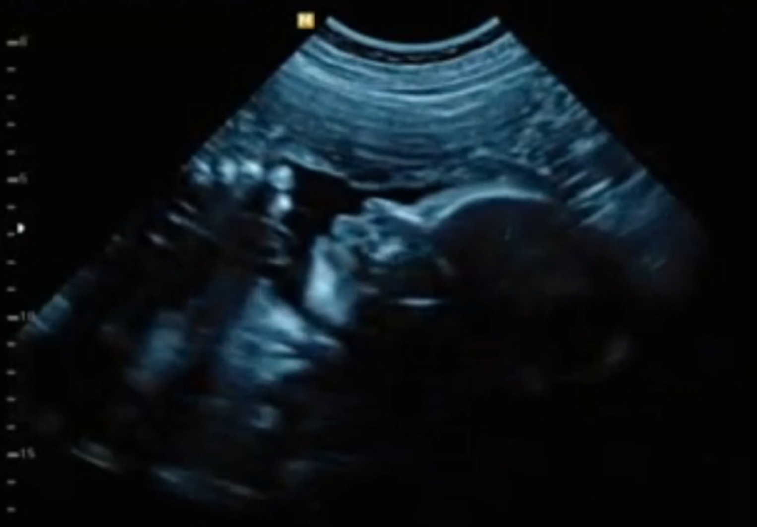Ultrassom de Caleb Bennett.